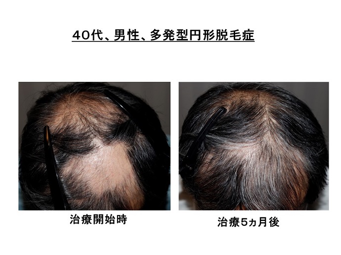 円形脱毛症　病院
